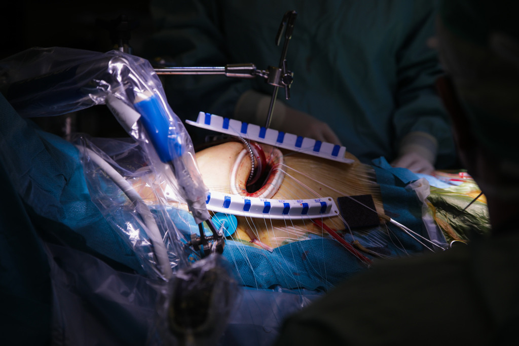 A szív bal pitvara és kamrája közötti, elégtelenül záró billentyűt endoszkópos eszközökkel javítják illetve mentik meg, így nincs szükség műbillentyű beültetésére