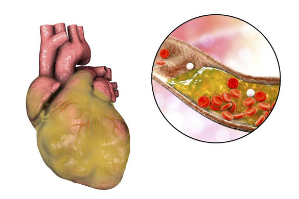 Hét étel fogyasztásával megelőzhető a szívinfarktus
