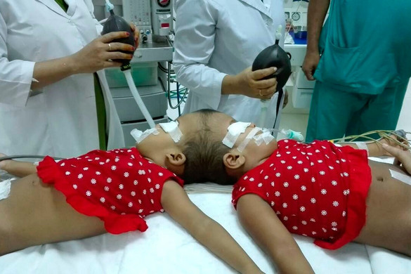 Sikeresen szétválasztották a fejüknél összenőtt bangladesi sziámi ikreket