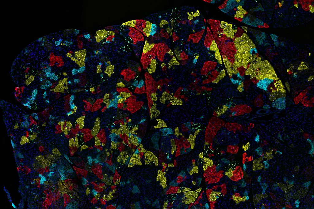 Hasnyálmirigy cellák rákos sejtjei
