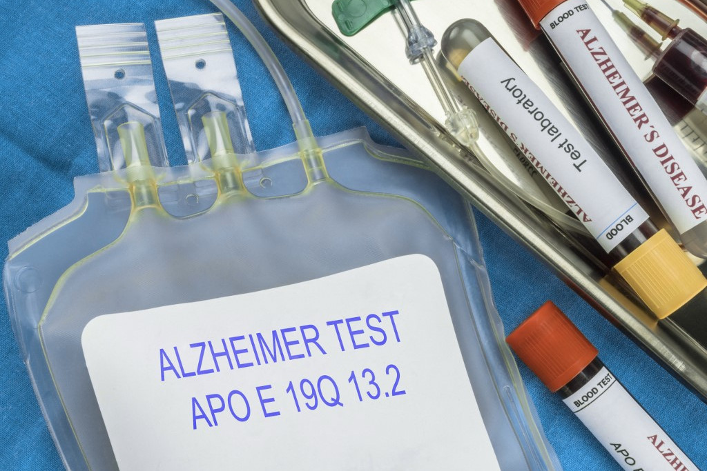 Az Alzheimer-kór vizsgálata vér kivonásával