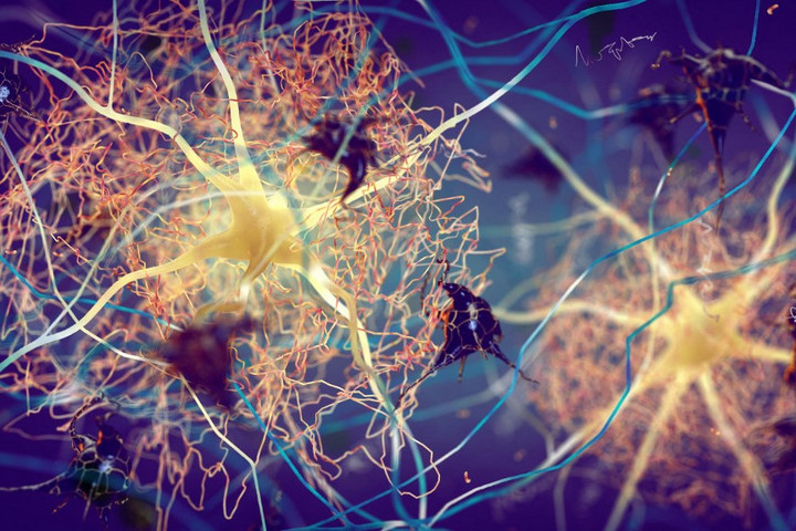 Fotó: AFP/NOBEASTSOFIERCE/SCIENCE PHOTO LI/DDJ A világ legfiatalabb Alzheimer-kóros betege