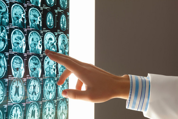 Kinél alakulhat ki stroke nagyobb eséllyel 60 éves kora előtt?