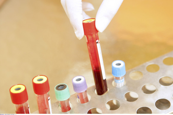 Már a harmadik HIV-beteget nyilvánították gyógyulttá az őssejtterápiának hála