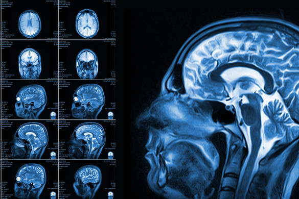 Az Alzheimer-kór nem fejben dől el