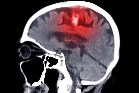 A speciális orrcseppek segíthetnek az agy felépülésében stroke után