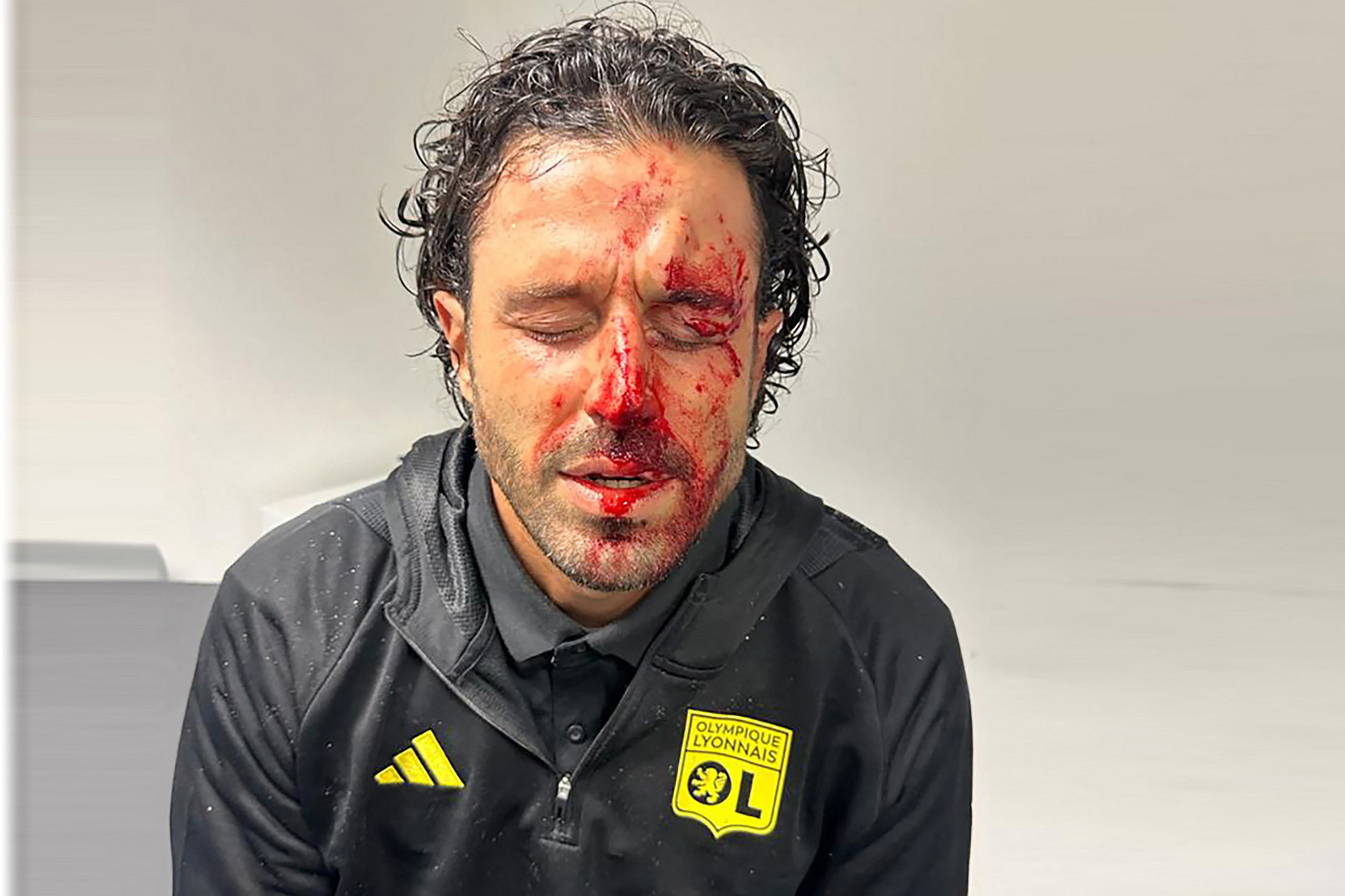 Olympique Marseille szurkolói megtámadták az Olympique Lyon autóbuszát, amelynek több ablaka is betört, a szilánkok felsértették Fabio Grosso vezetőedző arcát