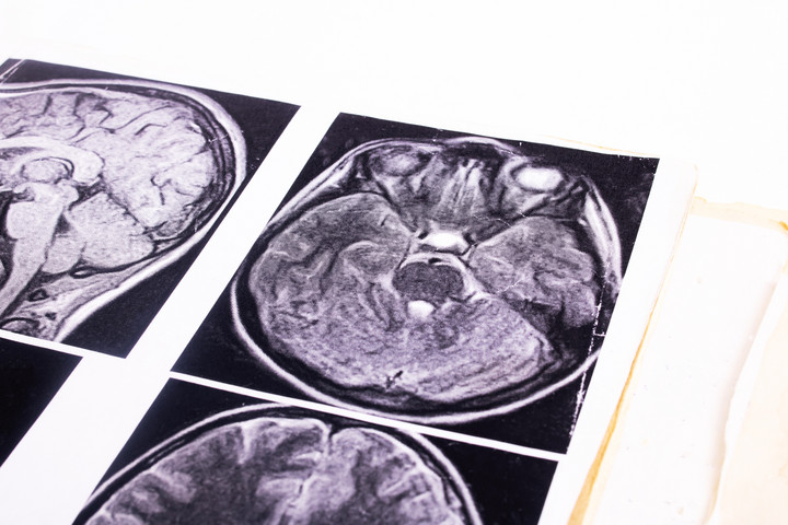 Megdöbbentő összefüggést találtak a vírusok, az Alzheimer-kór és a Parkinson-kór között