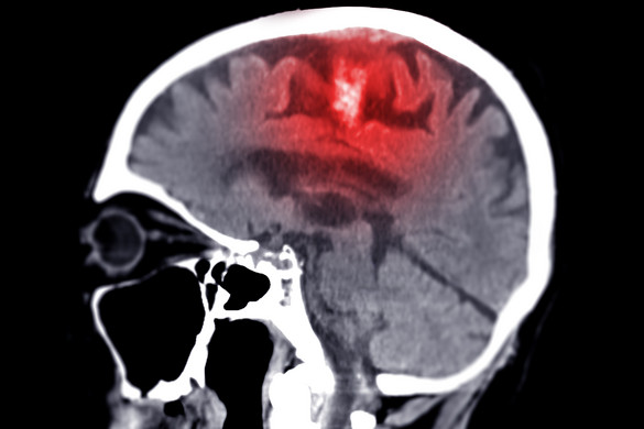 A mesterséges intelligencia képes megjósolni az agydaganat rövid és hosszú távú túlélőit