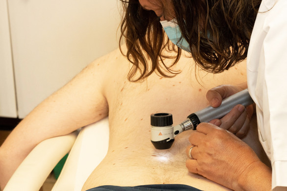 Így ismerhető fel a melanoma