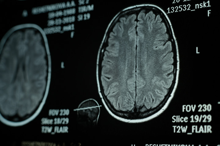 Antidepresszáns gyógyíthatja a leggyilkosabb rákot