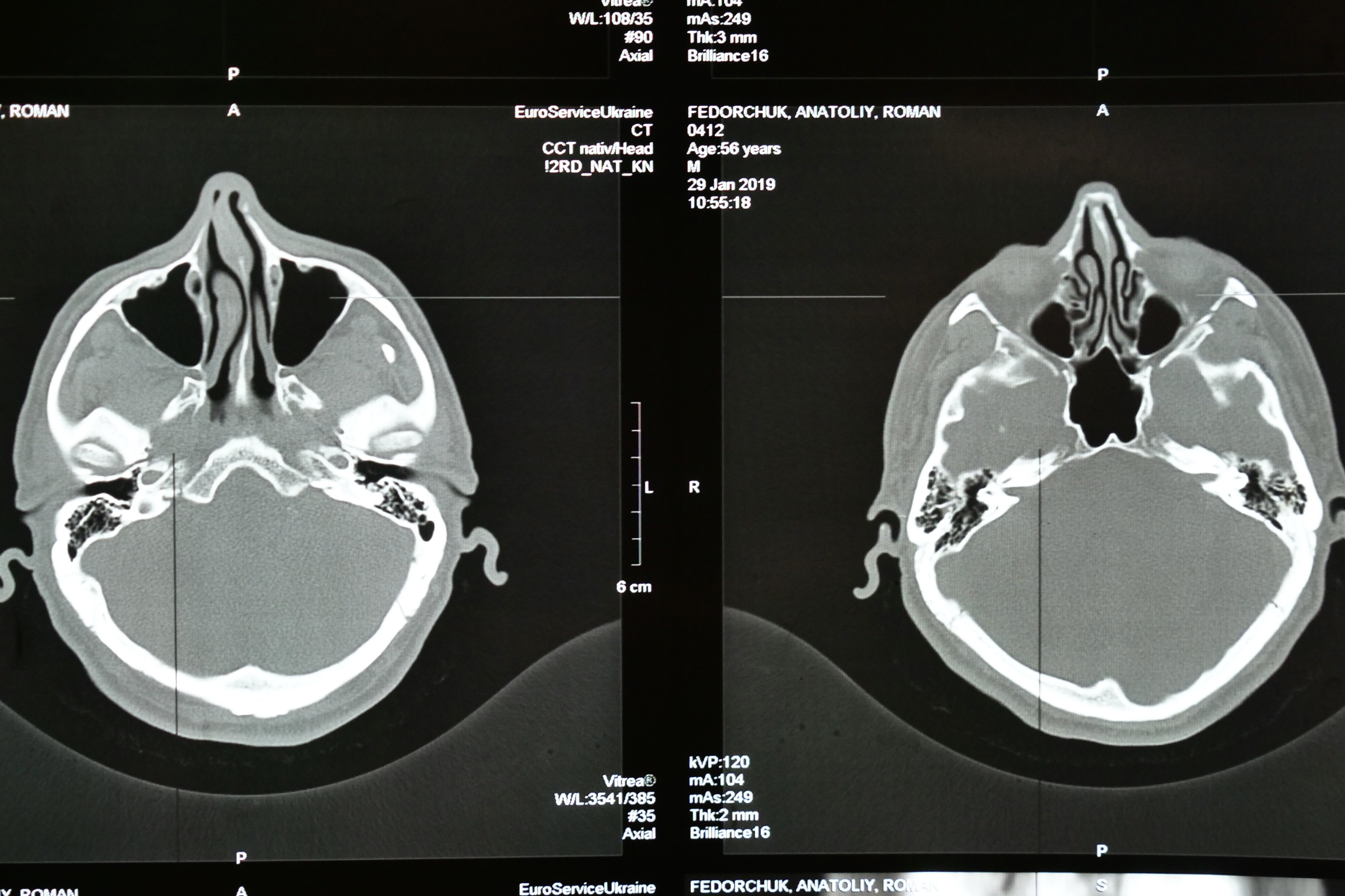 A stroke három legfontosabb kockázati tényezője