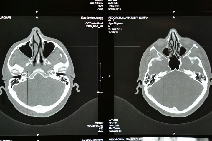 A stroke három legfontosabb kockázati tényezője