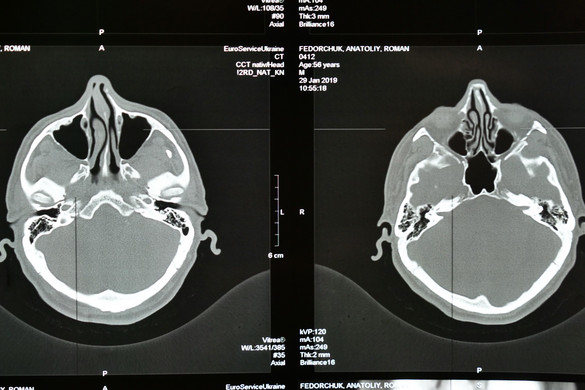 A stroke három legfontosabb kockázati tényezője