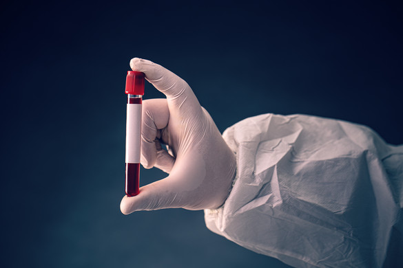 Jóváhagyták az első vérvizsgálatot az Alzheimer-kór diagnosztizálására