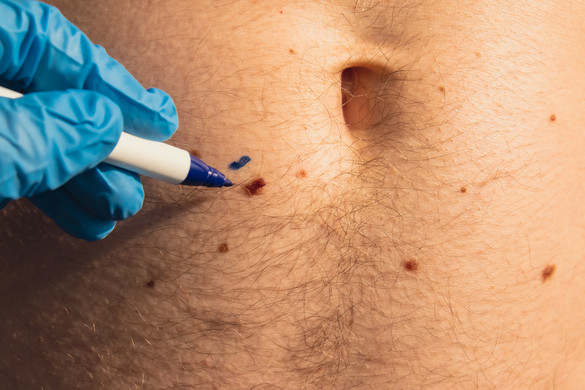 A bőrrák könyörtelen: a test ezen területeire kell kiemelten figyelni