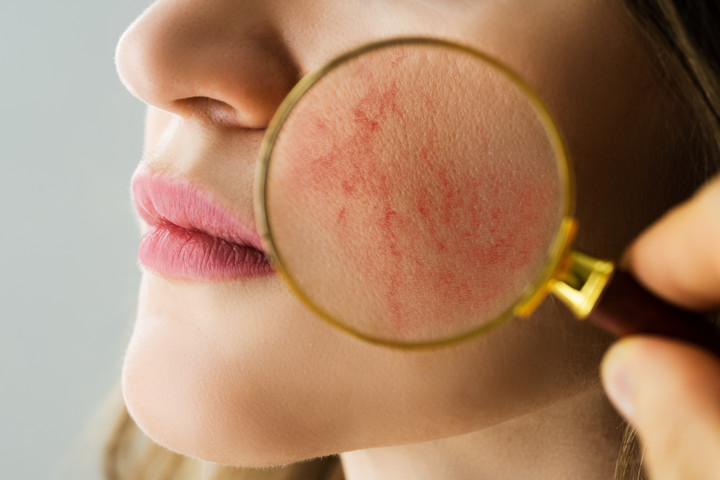 Fotó: NorthFoto A bőrgyógyász tippeket ad a bosszantó rosacea ellen