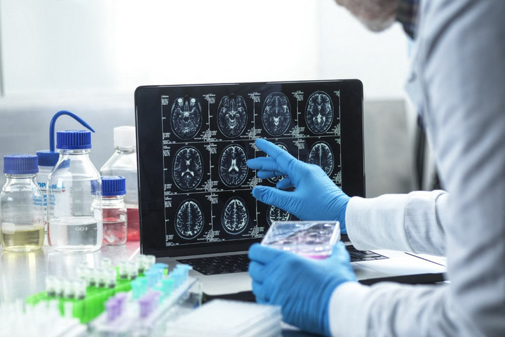 Fotó: TEK IMAGE / SCIENCE PHOTO LIBRARY / ABO / Science Photo Library via AFP Így előzhető meg a nőknél az Alzheimer-kór