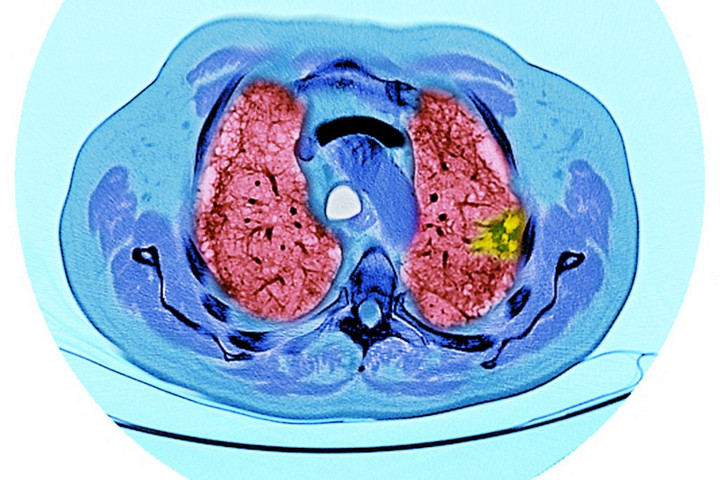 Fotó: DR P. MARAZZI / SCIENCE PHOTO LIBR / PMA / Science Photo Library via AFP Kitisztul-e a dohányos tüdő leszokás után? A tudomány válaszol