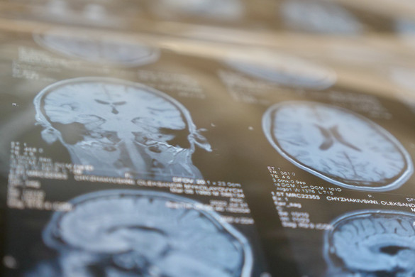 Fotó: NorthFoto Az agydaganat hét figyelmeztető jele