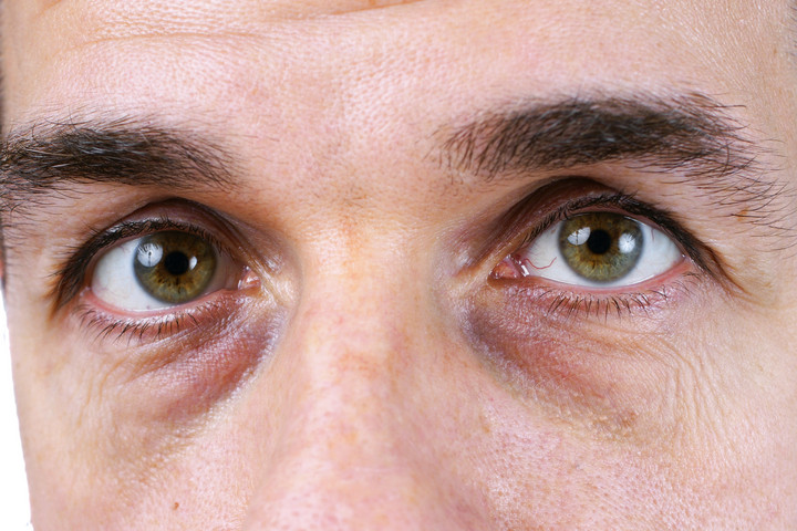 Fotó: NorthFoto Karikás szemek: lehet, hogy nem a fáradtság az oka