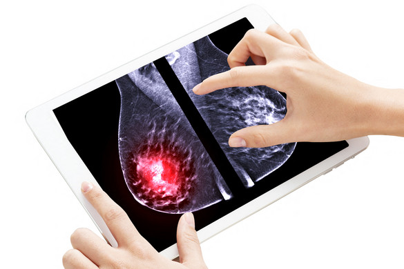 Mit lehet tudni a magyar kutatók által fejlesztett rákgyógyszerről?