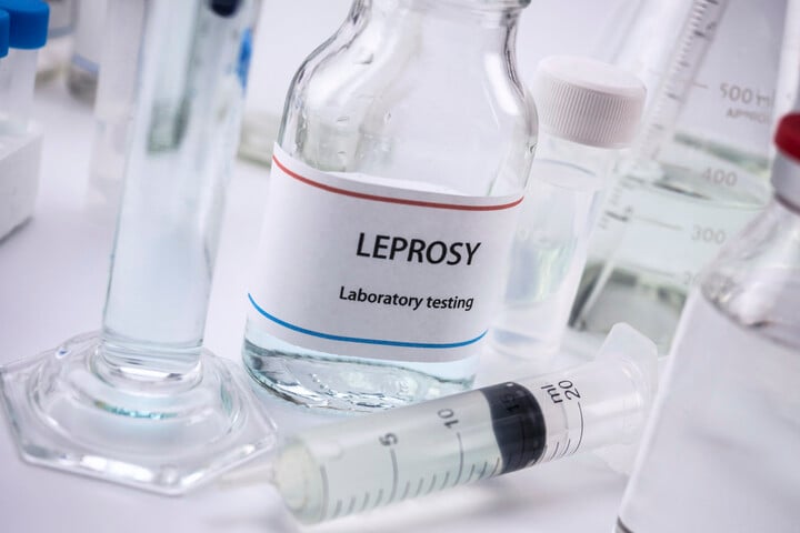 Fotó: Science Photo Library via AFP/DIGICOMPHOTO Terjed a lepra Romániában