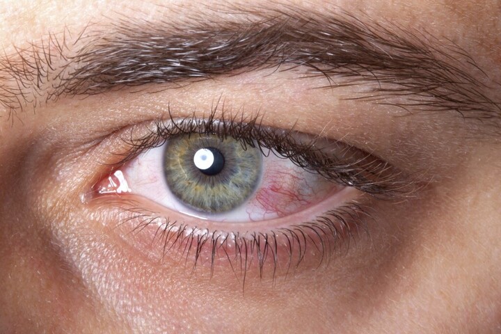 Ezek a magas koleszterinszint külső jelei