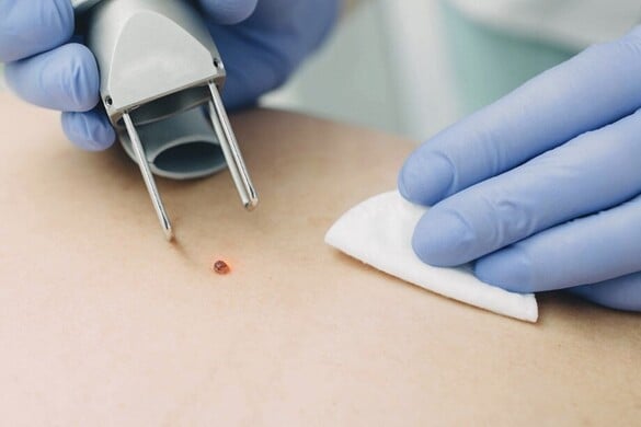 Rákosodhat a papilloma?