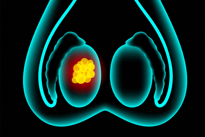 Fotó: PIKOVIT / SCIENCE PHOTO LIBRARY / TPA / Science Photo Library via AFP Már tizenéveseket is érinthet ez a daganatos betegség