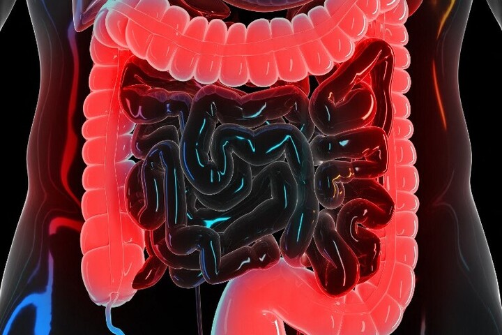 Hogyan alakul ki testünkben észrevétlenül a vastagbélrák