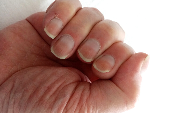 Milyen betegségre utalhat a száraz bőr és az állandóan hideg ujjak?