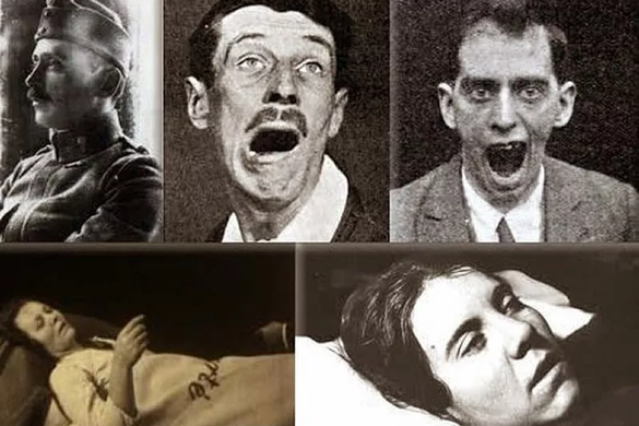 A furcsa betegség, amely 500 000 ember életét követelte, majd hirtelen eltűnt